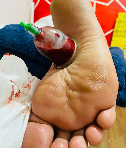 Hijama - Hafar Al Batin -